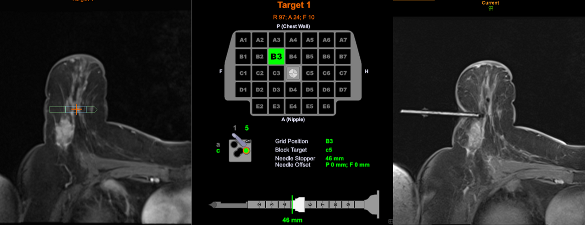 JHAH unveils precision imaging technology for breast cancer screening and diagnosis