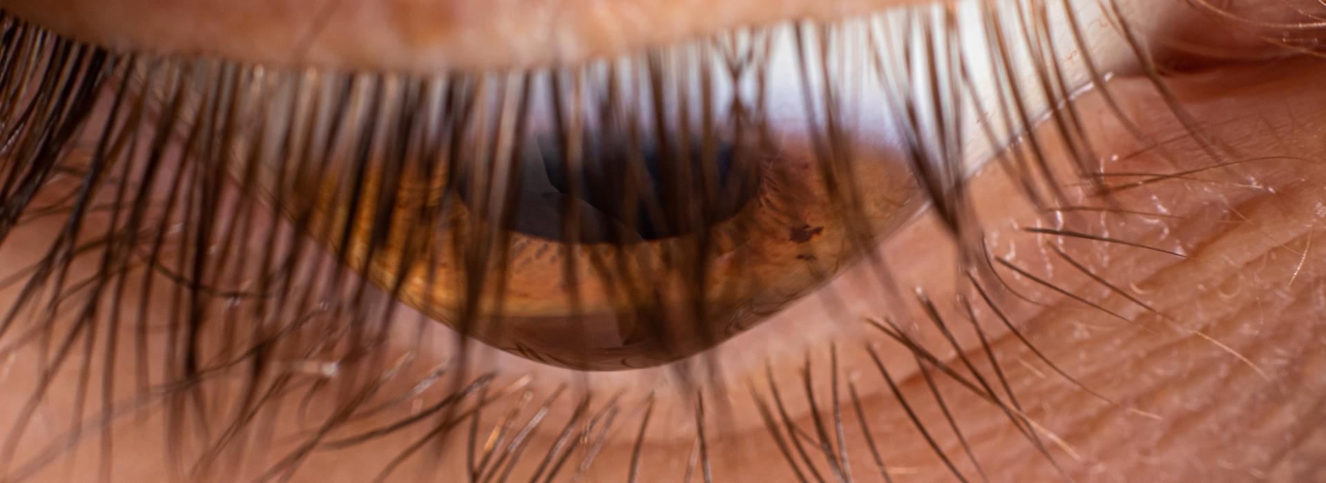 Keratoconus Screening at JHAH